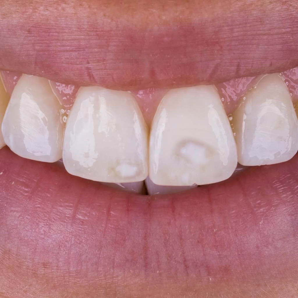manchas en los dientes