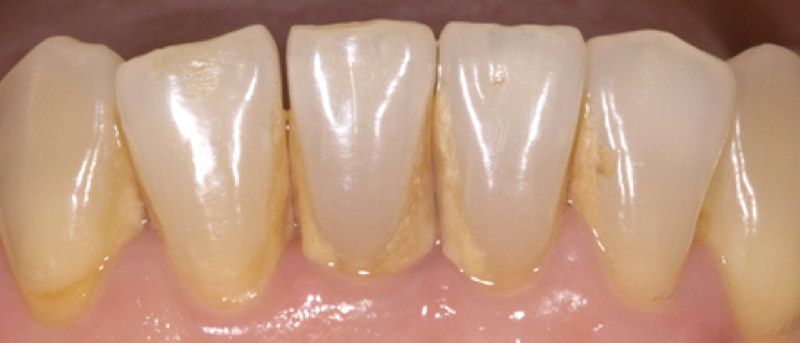 sarro en los dientes