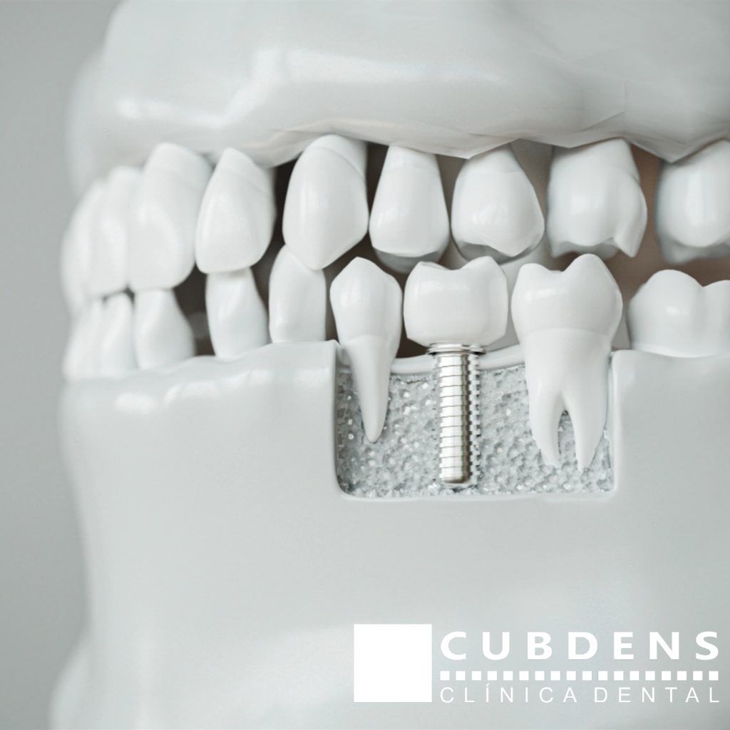 Implantes para dientes faltantes
