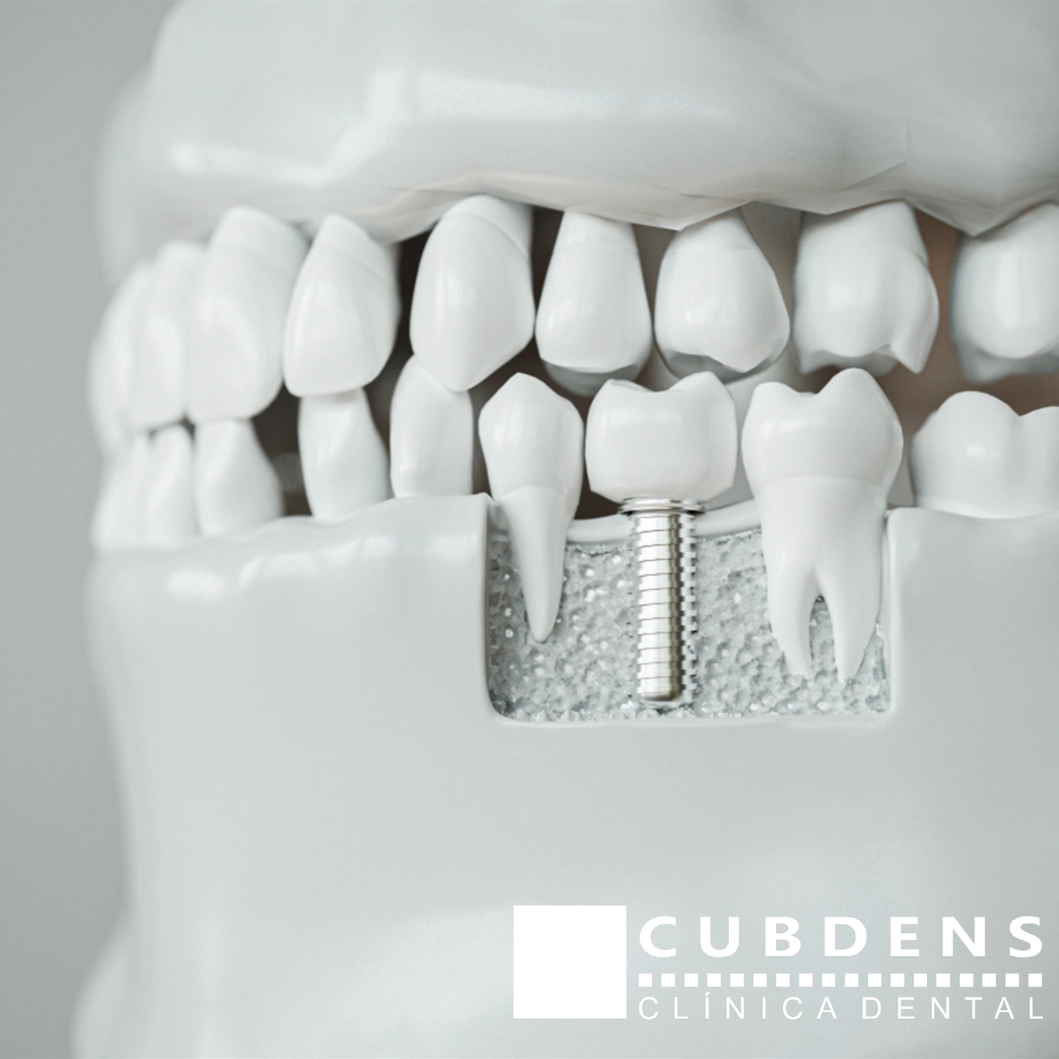 Implantes para dientes faltantes