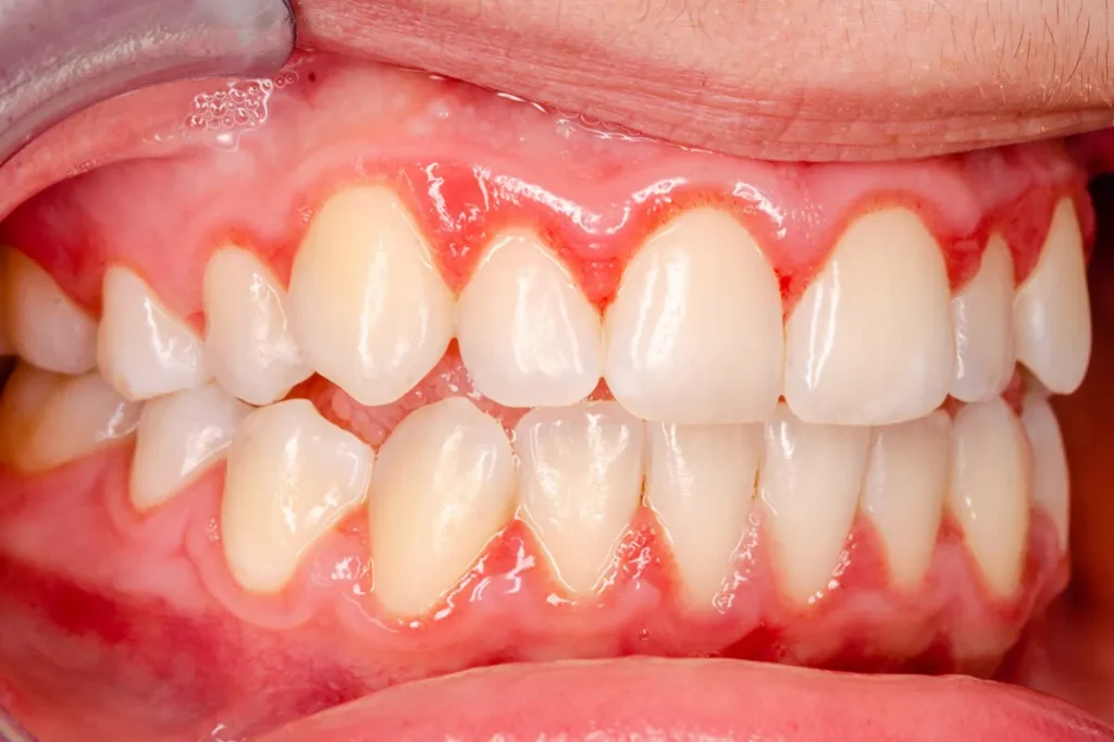 gingivitis